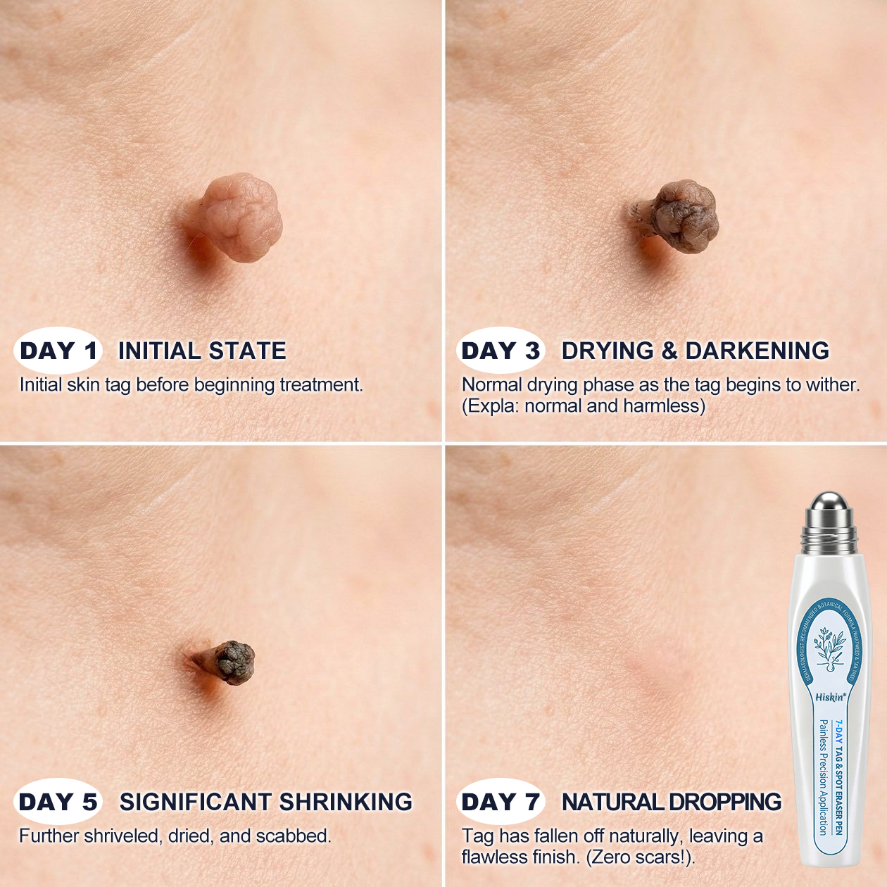 💖👩‍⚕️𝐎𝐟𝐟𝐢𝐜𝐢𝐚𝐥 𝐁𝐫𝐚𝐧𝐝 𝐒𝐭𝐨𝐫𝐞 |✅💎Hiskin ® 7-𝐷𝑎𝑦 𝗧𝐚𝐠 & 𝗦𝗽𝐨𝐭 𝐄𝐫𝒂𝒔𝒆𝒓(Zero Pain, Zero 𝐒𝐜𝐚𝒓𝒔 Rollerball)