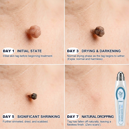 💖👩‍⚕️𝐎𝐟𝐟𝐢𝐜𝐢𝐚𝐥 𝐁𝐫𝐚𝐧𝐝 𝐒𝐭𝐨𝐫𝐞 |✅💎Hiskin ® 7-𝐷𝑎𝑦 𝗧𝐚𝐠 & 𝗦𝗽𝐨𝐭 𝐄𝐫𝒂𝒔𝒆𝒓(Zero Pain, Zero 𝐒𝐜𝐚𝒓𝒔 Rollerball)
