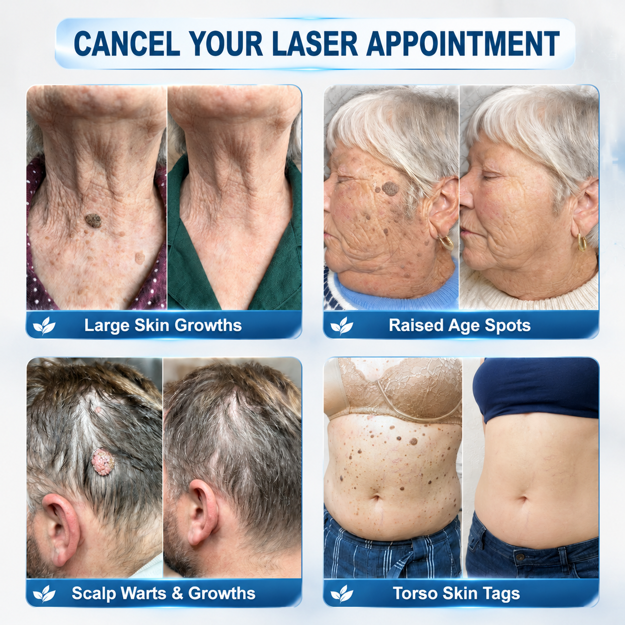 💖👩‍⚕️𝐎𝐟𝐟𝐢𝐜𝐢𝐚𝐥 𝐁𝐫𝐚𝐧𝐝 𝐒𝐭𝐨𝐫𝐞 |✅💎Hiskin ® 7-𝐷𝑎𝑦 𝗧𝐚𝐠 & 𝗦𝗽𝐨𝐭 𝐄𝐫𝒂𝒔𝒆𝒓(Zero Pain, Zero 𝐒𝐜𝐚𝒓𝒔 Rollerball)